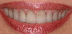 animation showing teeth getting whiter and brighter